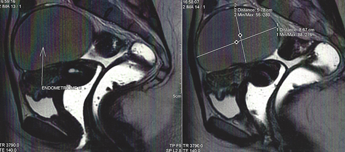 Endométriose