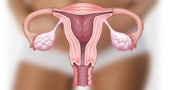 Prévention contre le cancer du col de l'utérus : la vaccination