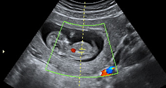 Échographies prénatales