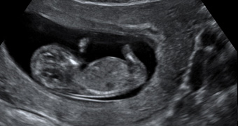 Échographies prénatales