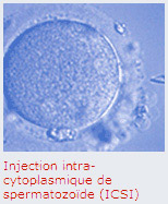 Injection intra-cytoplasmique de spermatozoïde (ICSI)