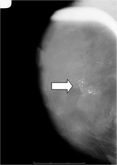 Des microcalcifications  groupées (petits points blancs) en mammographie : une biopsie (prélèvement) est nécessaire pour les caractériser